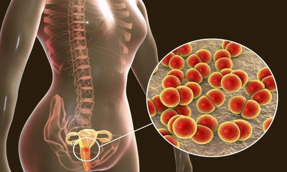 Penyakit Radang Panggul (Pelvic Inflammatory Disease/PID)