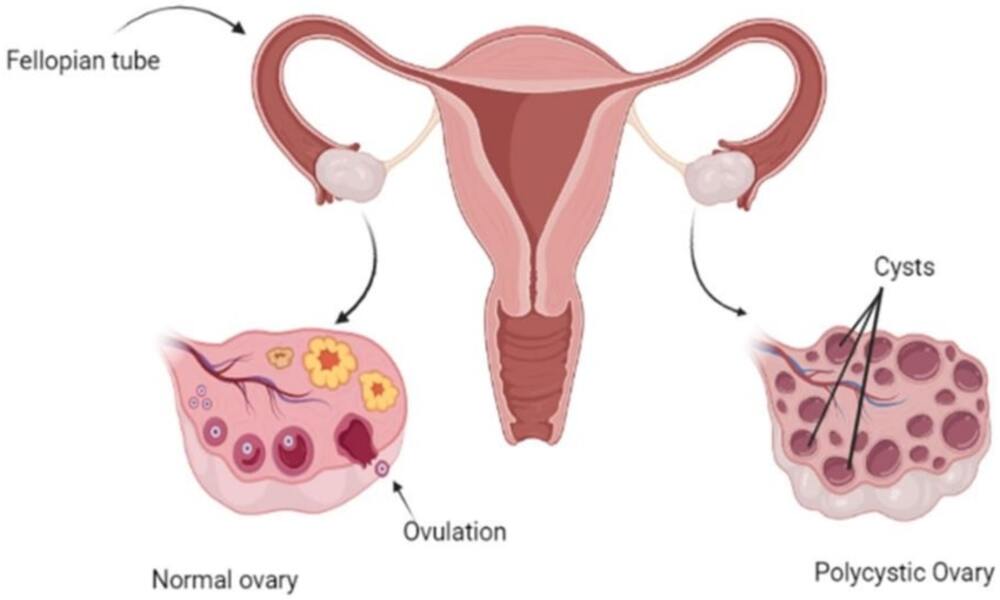 Sindrom Ovarium Polikistik (PCOS)