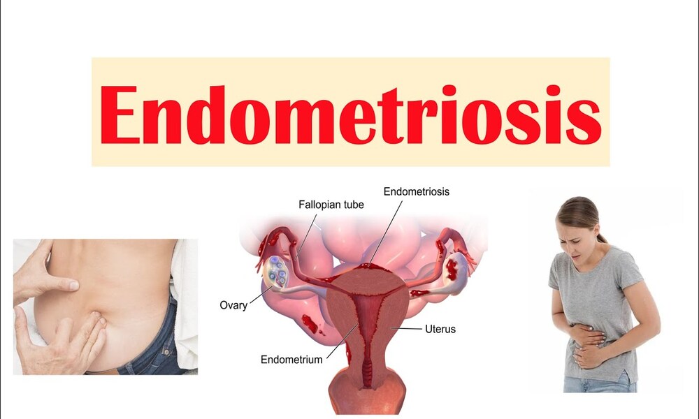 Endometriosis Berpengaruh Pada Siklus Mensturasi Wanita