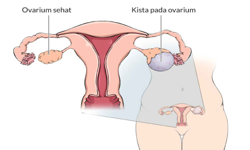 Penyebab Kista Pada Ovarium Wanita dan Pengobatannya